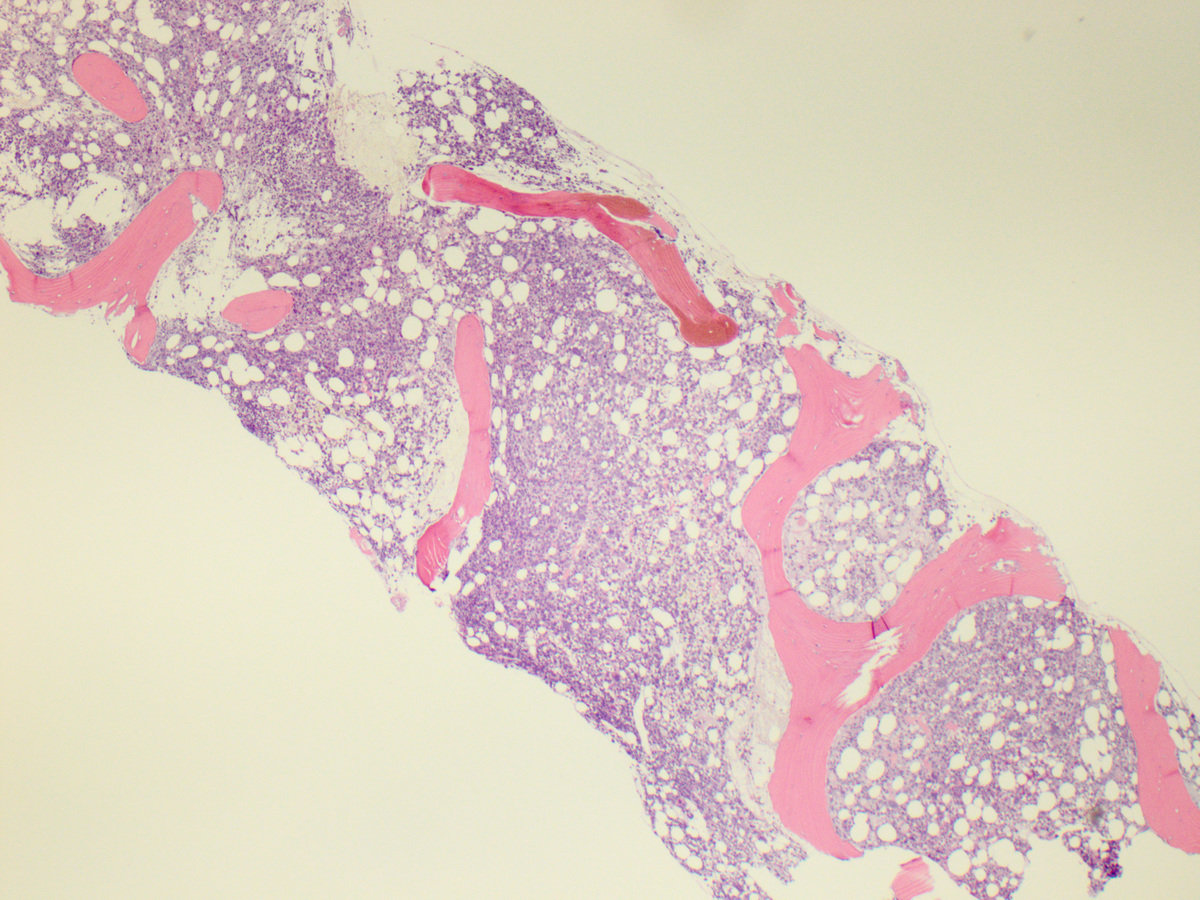 Bone marrow biopsy 4x